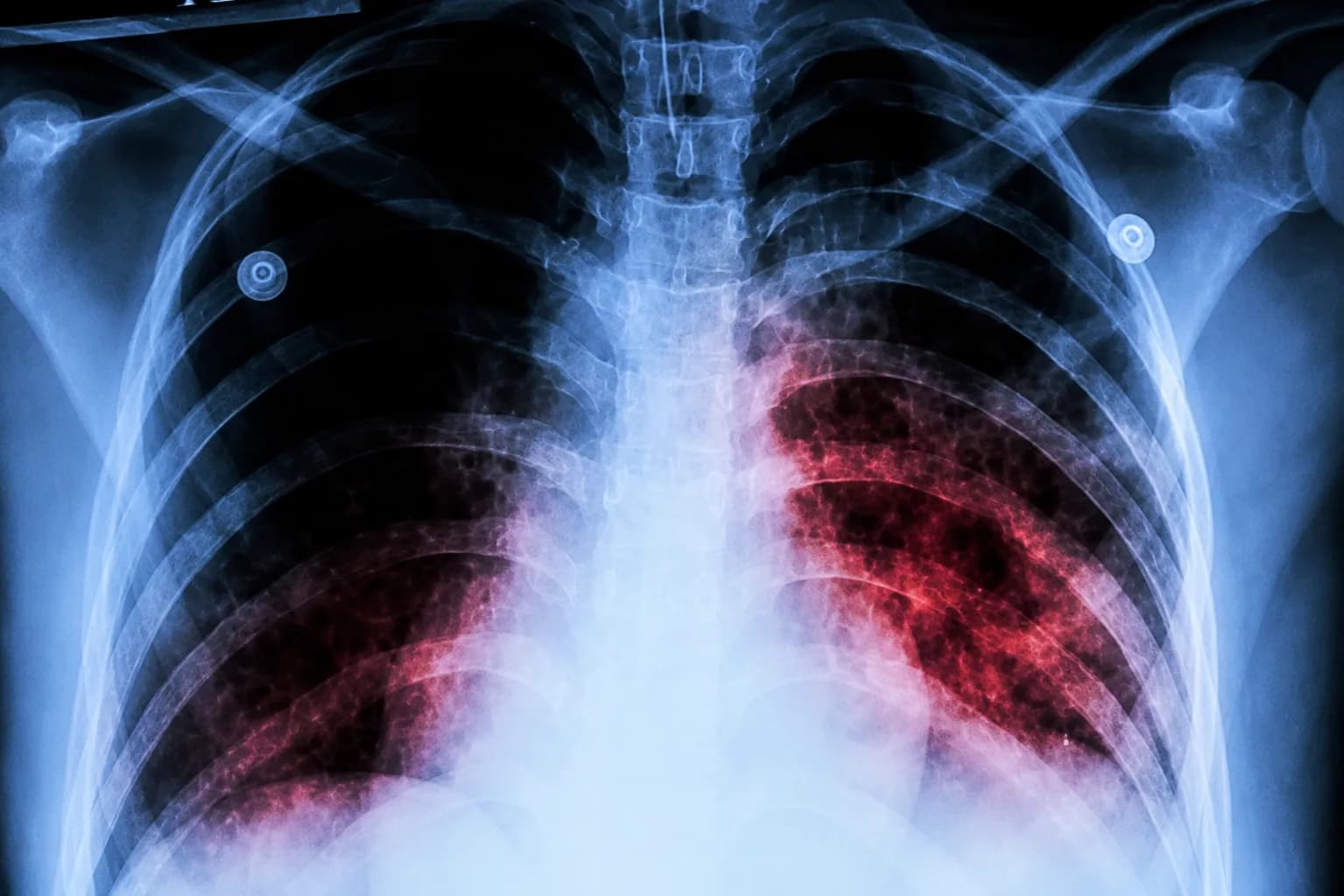 Tuberculosis Now Deadlier Than COVID, Doctors Warn