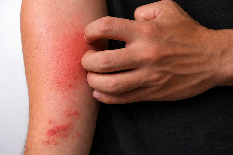 Child HIV Cases in Karachi